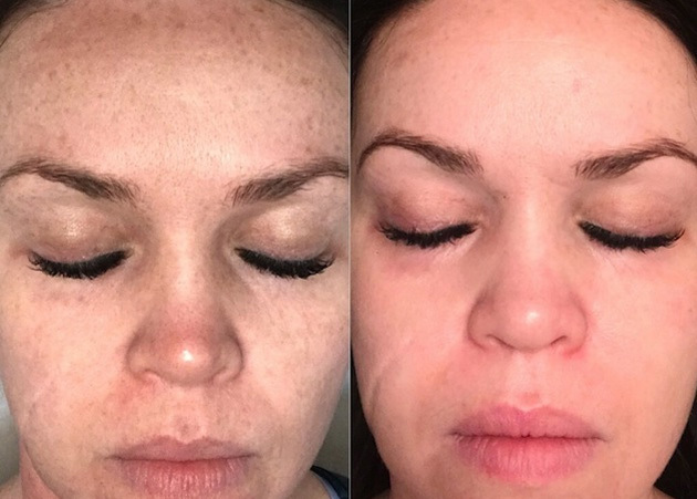 Pigmentation Treatment Before & After
