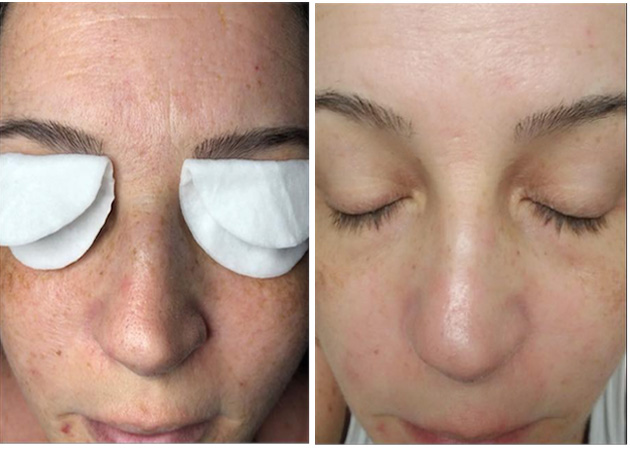 One Treatment Before & After-C Awaken Facial