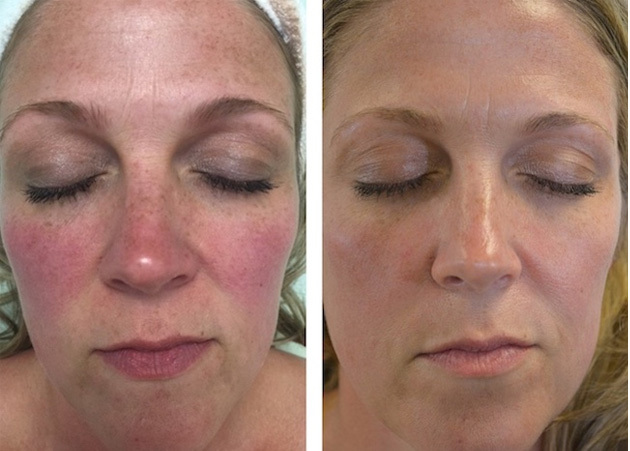 Rosacea 90 Day Live Before & After